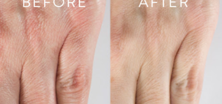 younger looking hands – see it to believe it